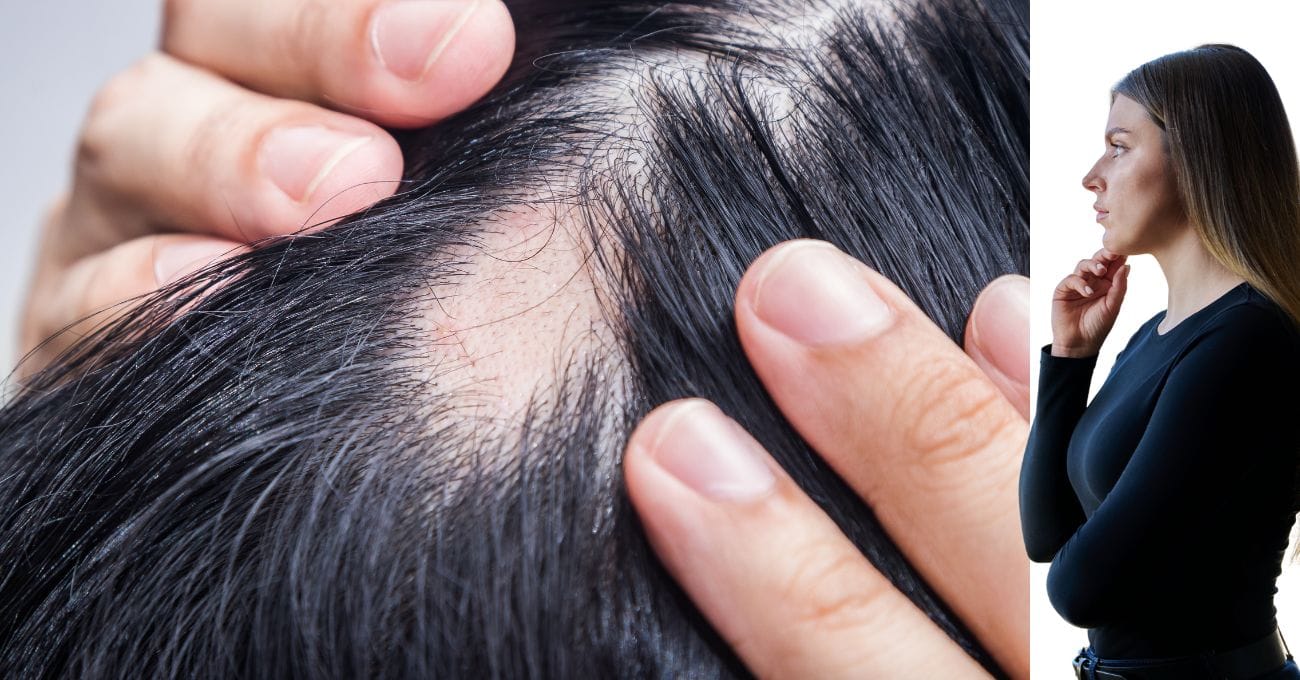 Alopecia Areata + long beauty juntos pra você