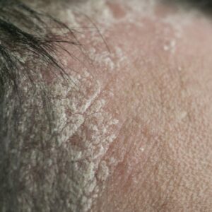 Descamação no Couro Cabeludo: Caspa ou Algo Além?