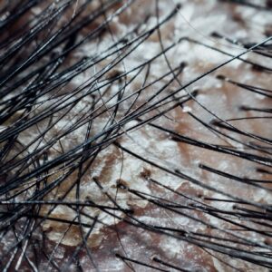 Oleosidade no Couro Cabeludo: Como Controlar e Manter o Equilíbrio dos Fios