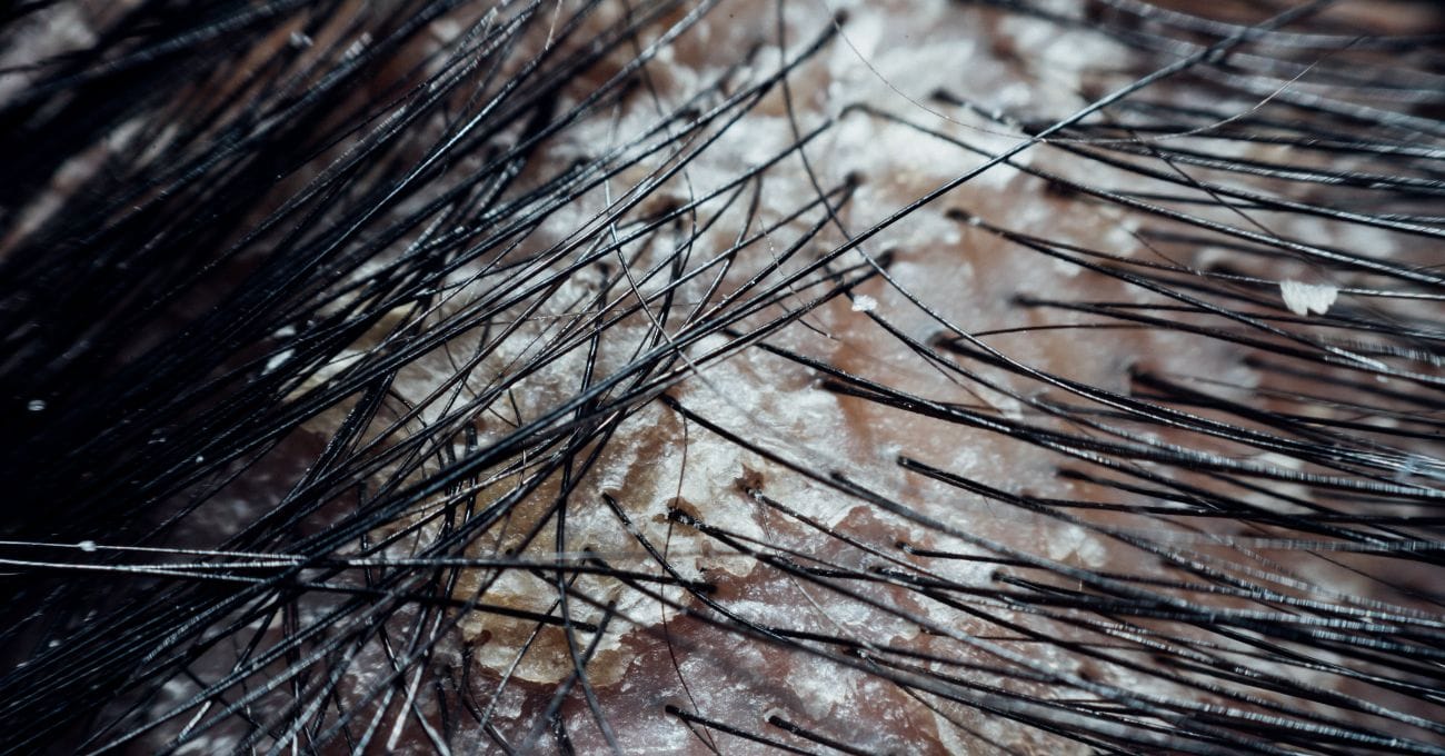 Oleosidade no Couro Cabeludo