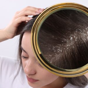 Caspa: Causas, Tipos e Tratamentos Que Realmente Funcionam