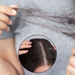 Caspa Causa Queda de Cabelo? Entenda a Conexão e Como Resolver os Dois Problemas