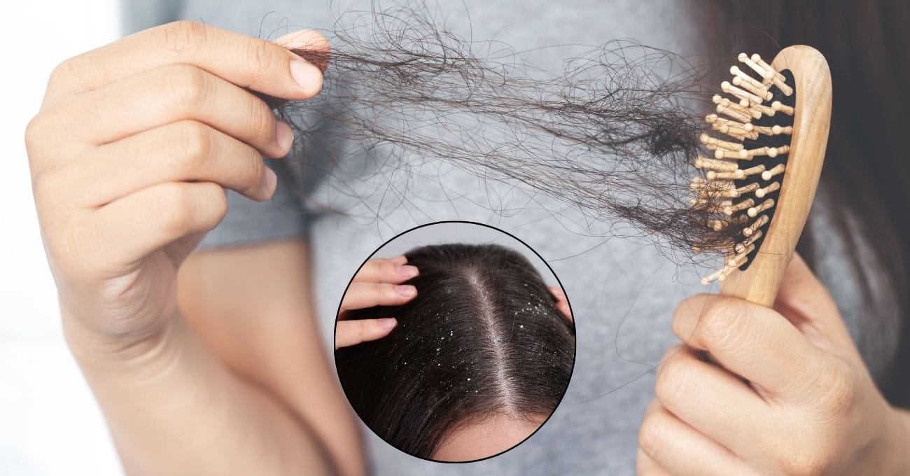 Caspa Causa Queda de Cabelo