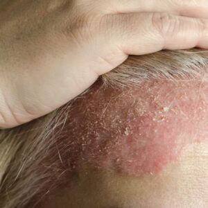 Dermatite na Cabeça: Causas, Sintomas, Tratamento e Como Curar Definitivamente