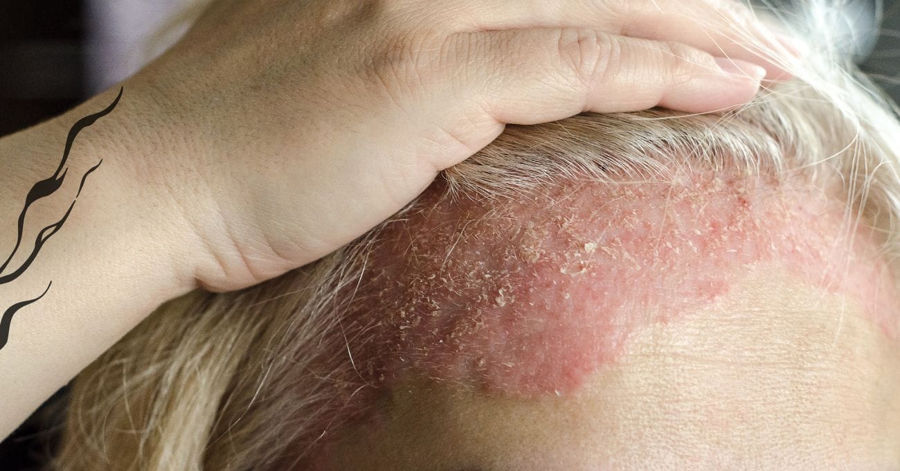 Dermatite na Cabeça