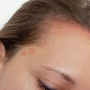 Seborreia: O Que É, Causas, Sintomas e Tratamento Completo Para Couro Cabeludo