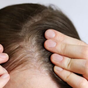 6 Razões Pelas Quais Suas Entradas no Cabelo Estão Ficando Mais Evidentes