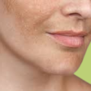 Melasma: O Que É, Causas e Como Tratar Naturalmente